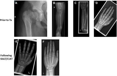 Bone health in children with primary hyperoxaluria type 1 following liver and kidney transplantation